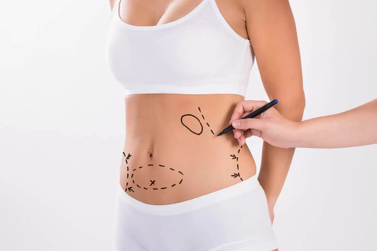 ankara liposuction tedavisi