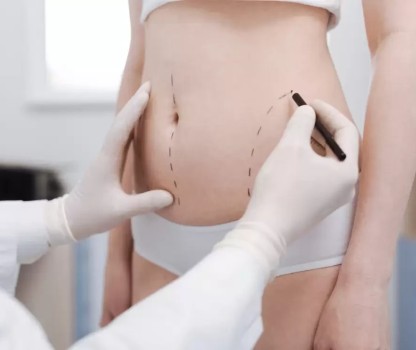 Liposuction’ı Hangi Mevsimde Yaptırmak Gerekir? Sonrası Denize, Havuza Girilebilir Mi?